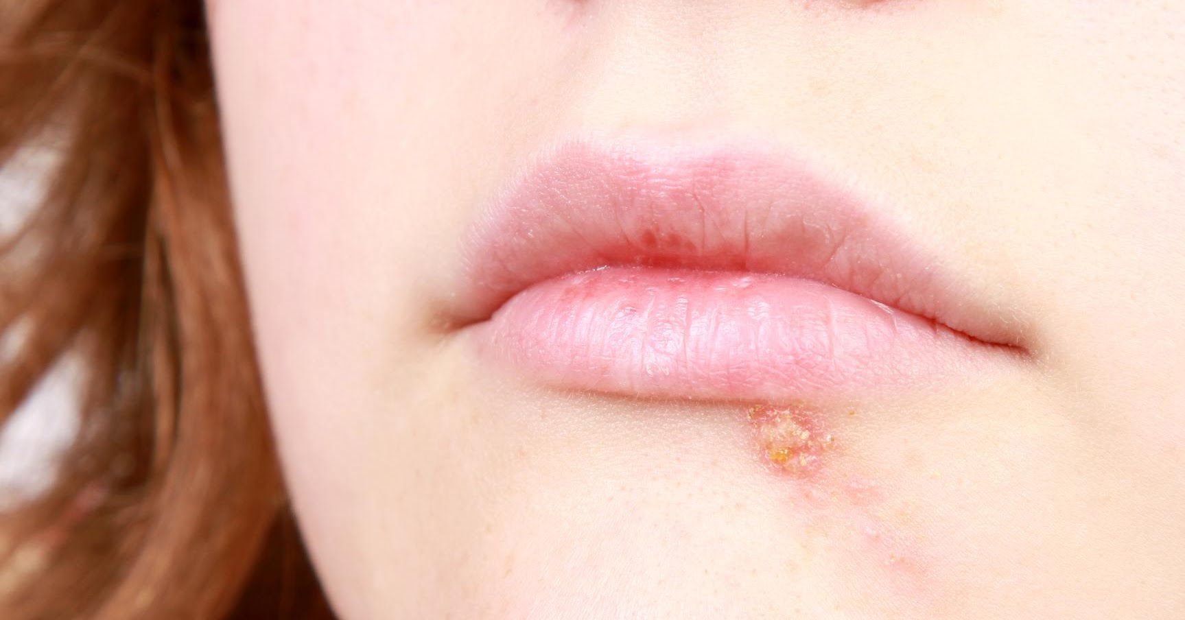 He has herpes Page 2 Lipstick Alley